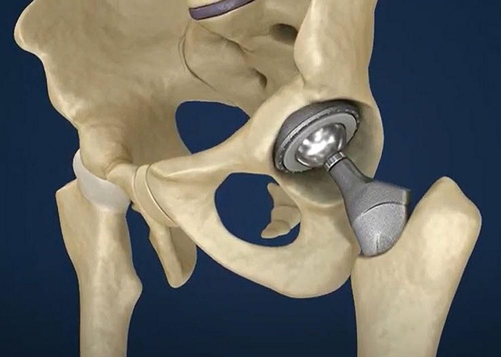 Key Insights into Femoral Component Manufacturing for Modern Orthopedic Solutions