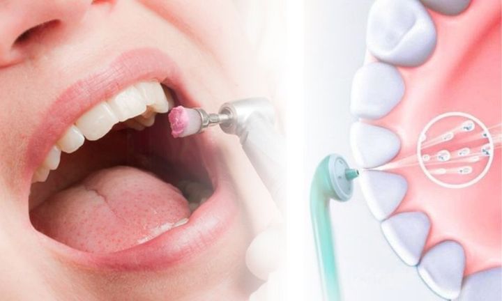 Complete Dental Cleaning Guide: Learn Facts, Tips, Advice, and Oral Care Insights
